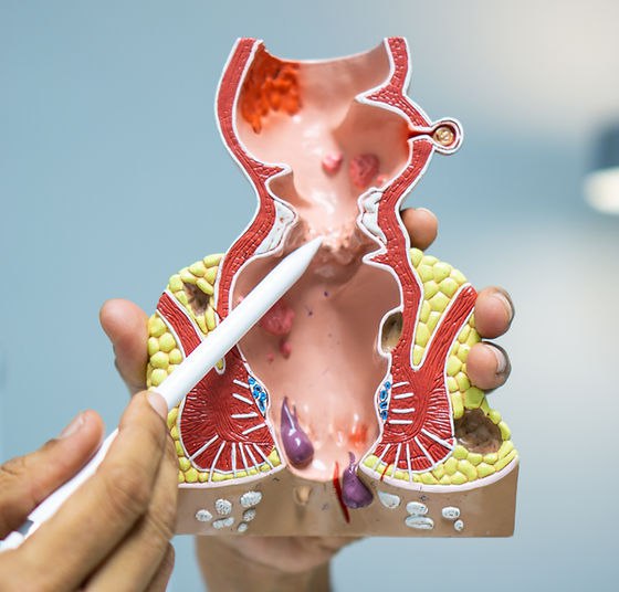 ОПЕРАТИВНОЕ ЛЕЧЕНИЕ ГЕМОРРОЯ В АРМАВИРЕ | ЦЕНТР АМБУЛАТОРНОЙ ХИРУРГИИ