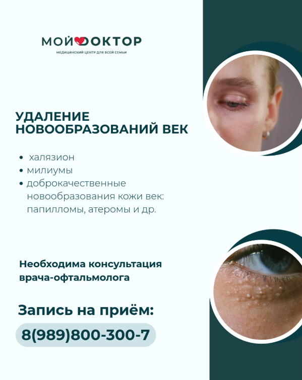 Новообразование на веке: удалить папилломы, милиумовы, ксантелазмы, невусы, кисты в Армавире