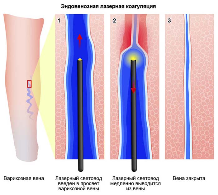 endovenoznaya-lazeernaya-koagulaciya.jpg